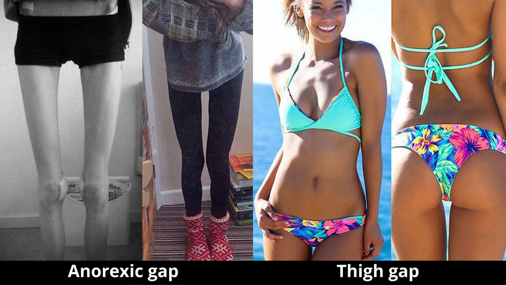 Anorexic gap vs thigh gap.